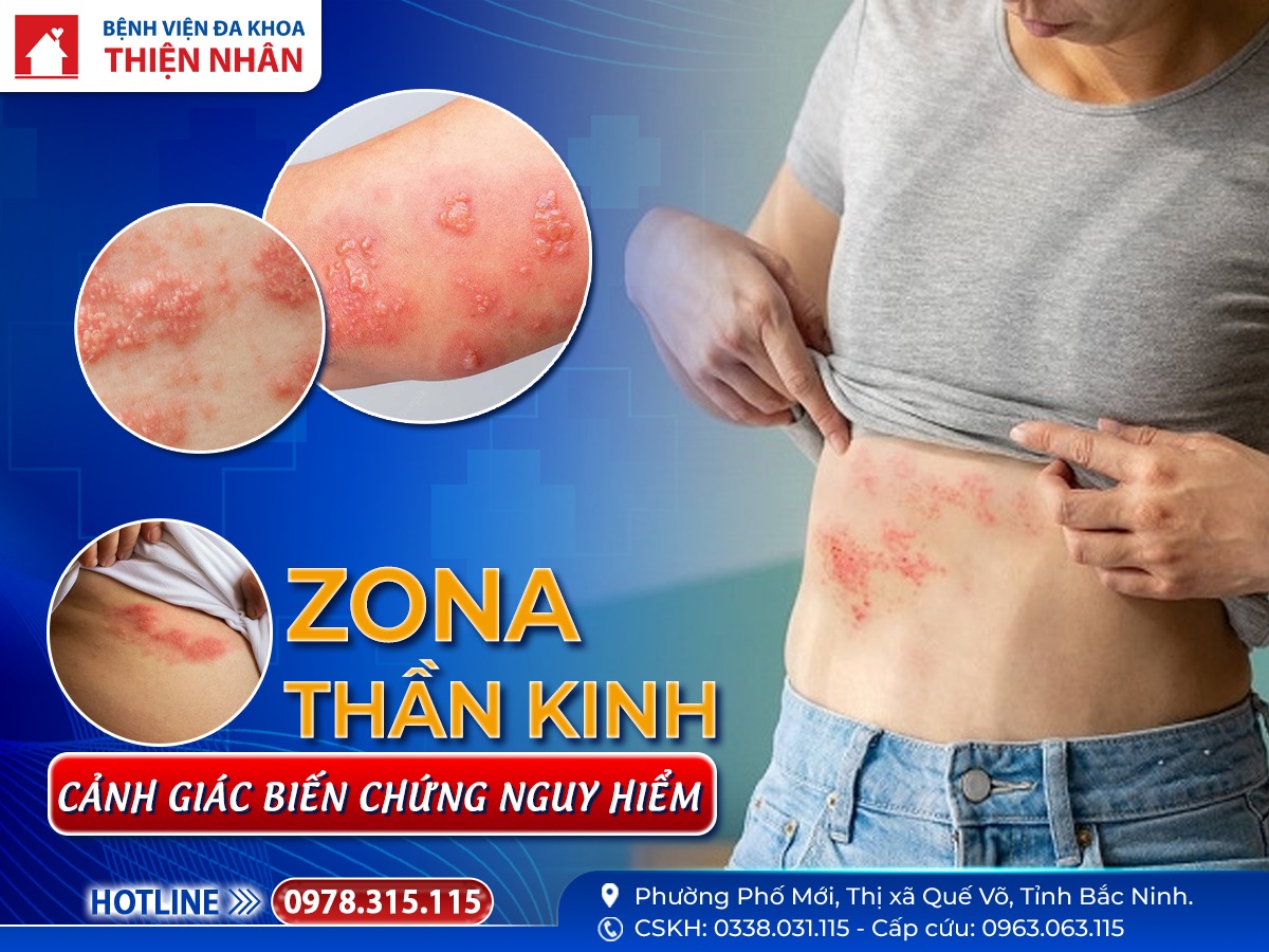https://benhvienthiennhan.com/canh-giac-voi-bien-chung-nguy-hiem-cua-benh-zona-than-kinh